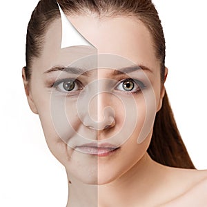 Woman`s face before and after rejuvenation.