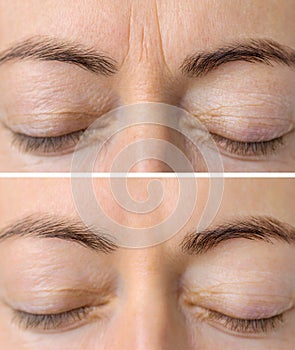 Woman`s face skin before and after aesthetic beauty cosmetic procedures with removed skin wrinkles