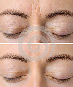 Woman`s face skin before and after aesthetic beauty cosmetic procedures with removed skin wrinkles photo