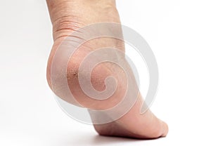 A woman`s foot heel close-up with problematic dry skin and cracks in the skin. The concept of dermatology, treatment of diseases