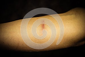 Woman's forearm with scar from self harm