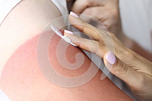 Woman`s hand applies cream to burn to treat sunburn.