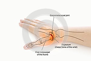 Woman\'s hand with thumb pain problem, body injured concept.