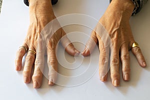 Woman`s hands affected by arthritis