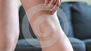 Woman`s leg with varicose veins. Treatment with cream.