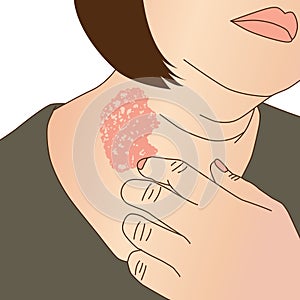 Woman\'s neck scratching because of itching from infection fungus or tinea versicolor,