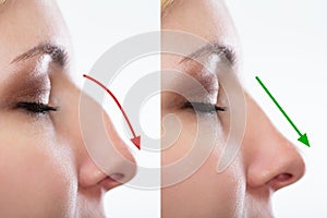 Woman`s Nose Before And After Plastic Surgery photo