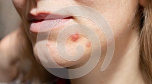 Woman`s oily skin with acne problems. Scars and wounds on the face. Health care photo