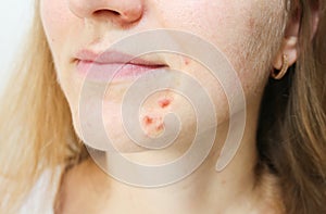 Woman`s oily skin with acne problems. Scars and wounds on the face. Health care photo