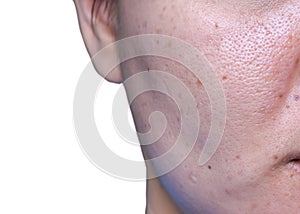 Woman `s problematic skin , acne scars ,oily skin and pore, dark spots and blackhead and whitehead on the face