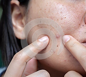 Woman`s problematic skin , acne scars ,oily skin and pore, dark spots and blackhead and whitehead on the face