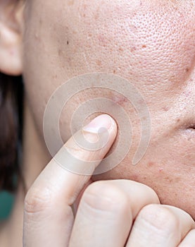 Woman`s problematic skin , acne scars ,oily skin and pore, dark spots and blackhead and whitehead on the face