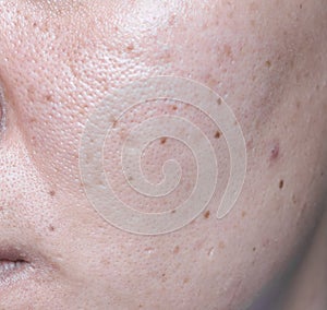 Woman`s problematic skin , acne scars ,oily skin and pore, dark photo