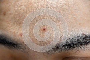 Woman`s problematic skin pore