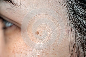 Woman`s problematic skin pore
