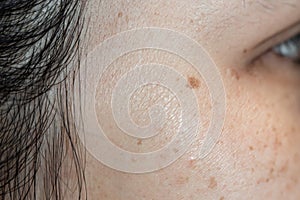 Woman`s problematic skin pore and dark spots