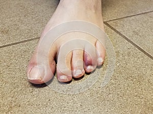 Woman`s red and purple bruised toe on tile floor