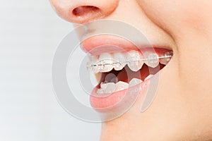 Woman`s smile with clear dental braces on teeth