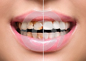 Woman's teeth before and after whitening photo