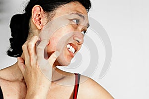 Woman scratch face with skin rash