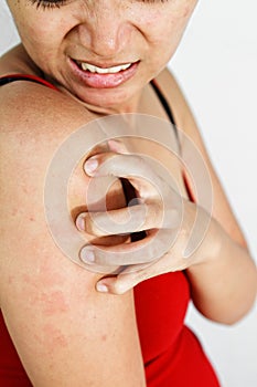 Woman scratch itchy arm