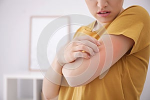 Woman scratching arm indoors, closeup. Allergy symptoms