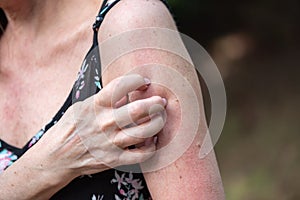 Woman scratching her arm