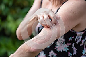 Woman scratching her arm