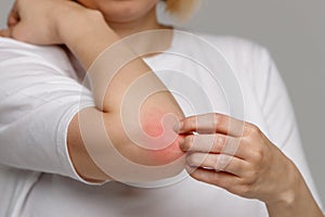 Woman scratching her arm and red elbow from allergy