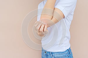 Woman scratching her elbow.