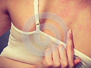 Woman scratching her itchy back with allergy rash