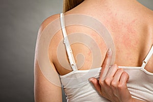 Woman scratching her itchy back with allergy rash