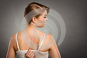 Woman scratching her itchy back with allergy rash