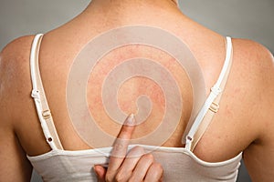 Woman scratching her itchy back with allergy rash