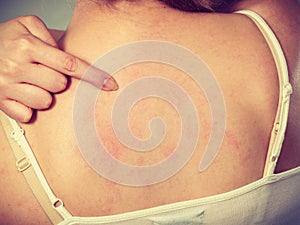 Woman scratching her itchy back with allergy rash