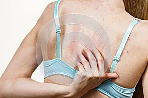 Woman scratching her itchy back with allergy rash