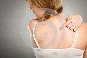 Woman scratching her itchy back with allergy rash photo