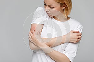 Woman scratching the itch on her hand. Dry skin, animal/food allergy, dermatitis photo