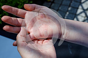 Woman scratching itchy hand, Concept, Atopic dermatitis, Red hands, Dermatological problem photo