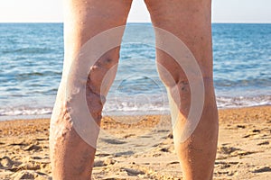 woman at sea with sore legs, bumps on her shins, thrombophlebitis of the veins of the lower extremities