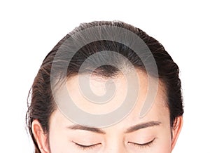 Woman serious hair loss problem for health care shampoo and beau