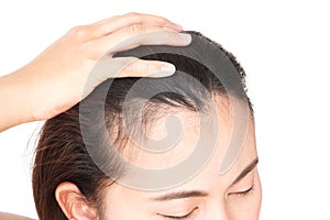 Woman serious hair loss problem for health care shampoo and beau