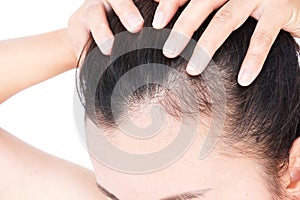 Woman serious hair loss problem for health care shampoo and beau