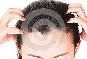 Woman serious hair loss problem for health care shampoo and beau