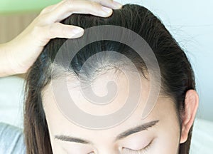 Woman serious hair loss problem for health care shampoo and beau