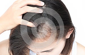 Woman serious hair loss problem for health care shampoo and beau