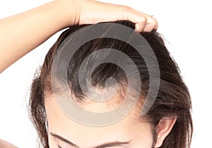 Woman serious hair loss problem for health care shampoo and beau