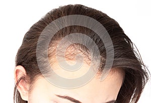 Woman serious hair loss problem for health care shampoo and beau