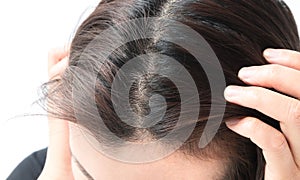 Woman serious hair loss problem for health care shampoo and beau