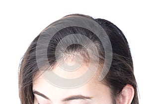 Woman serious hair loss problem for health care shampoo and beau